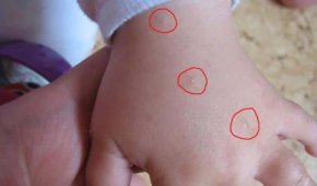 Начальная стадия чесотки у детей